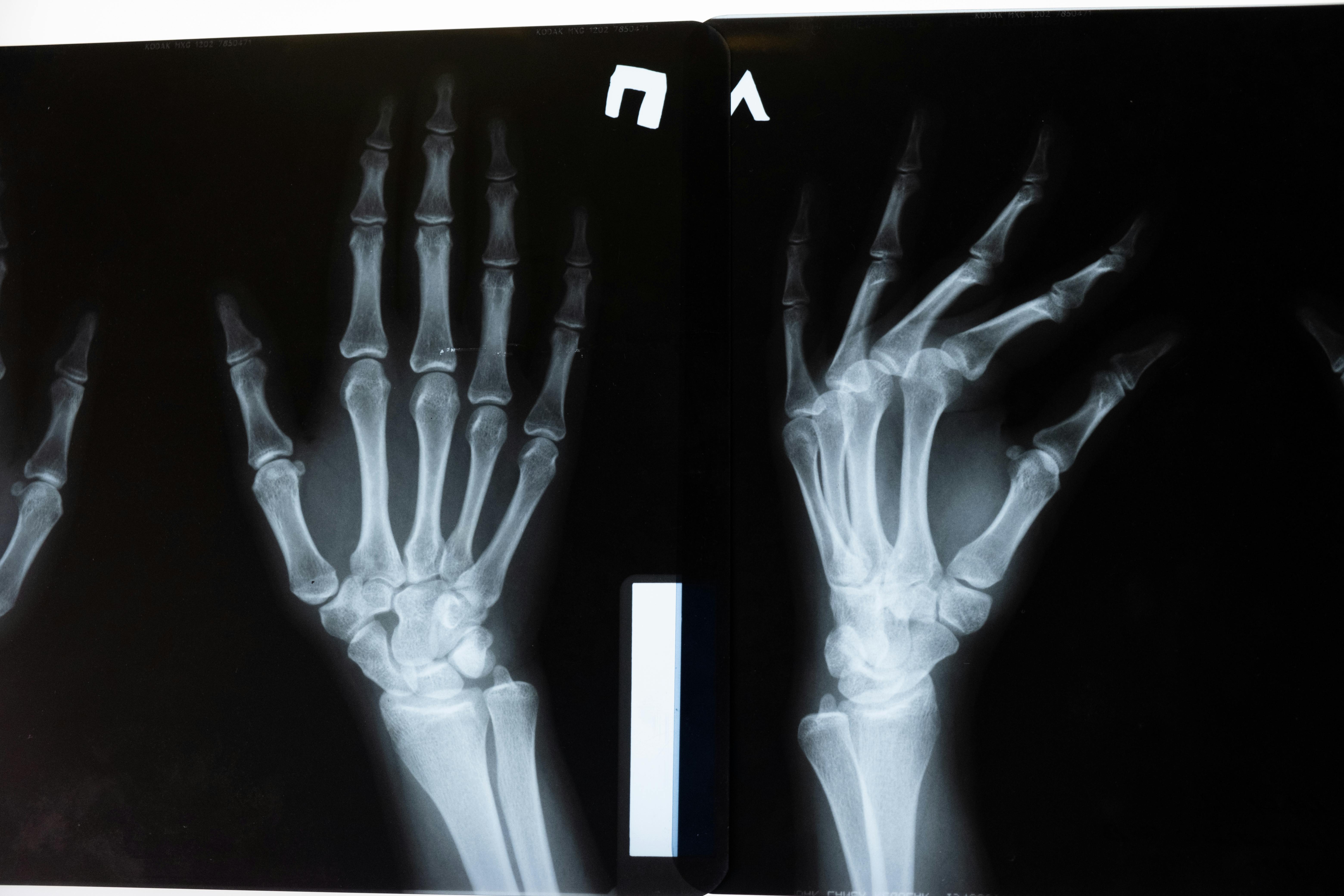 Hand x-ray films viewed in a clinical setting.