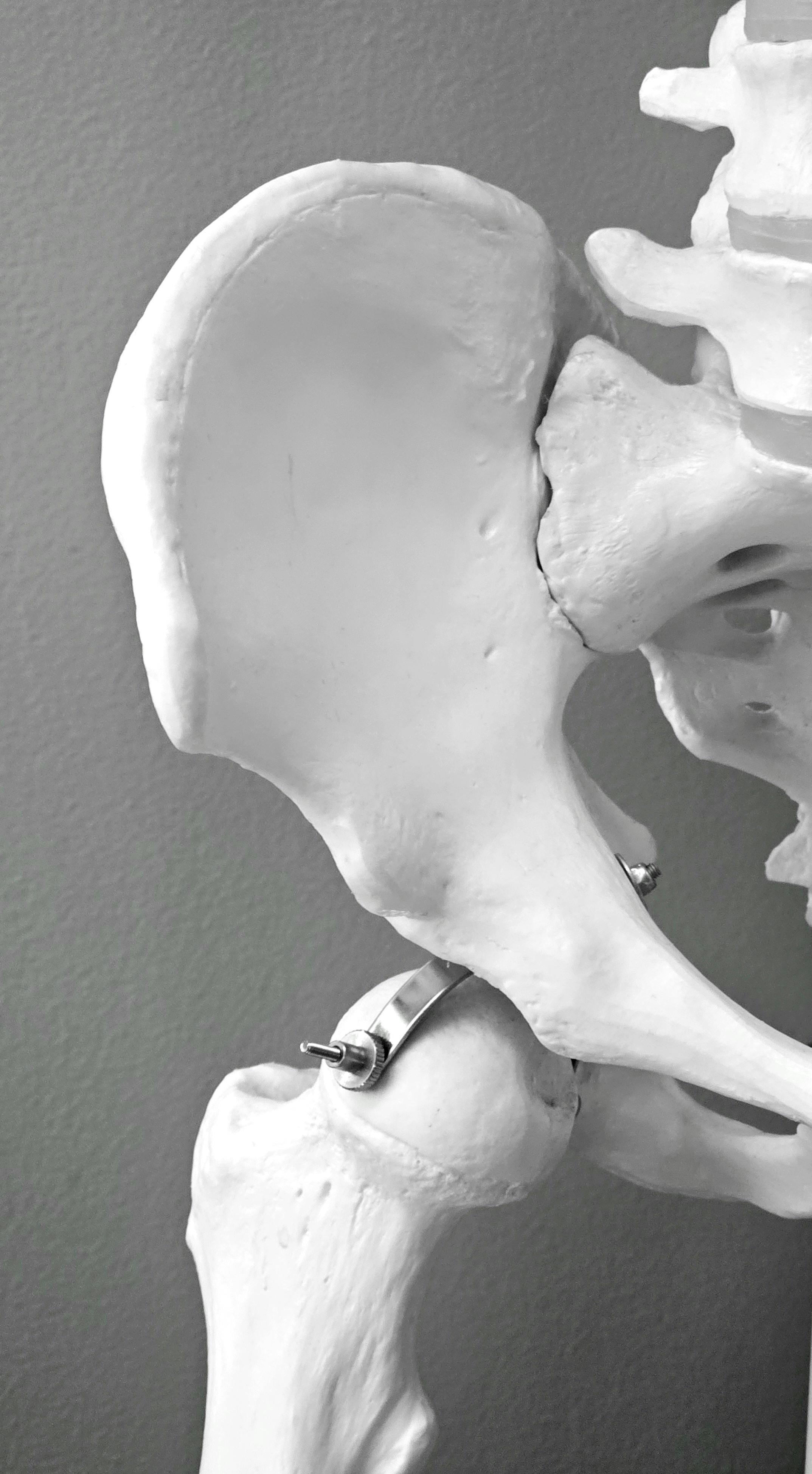 Orthopaedic hip model showing a joint implant.